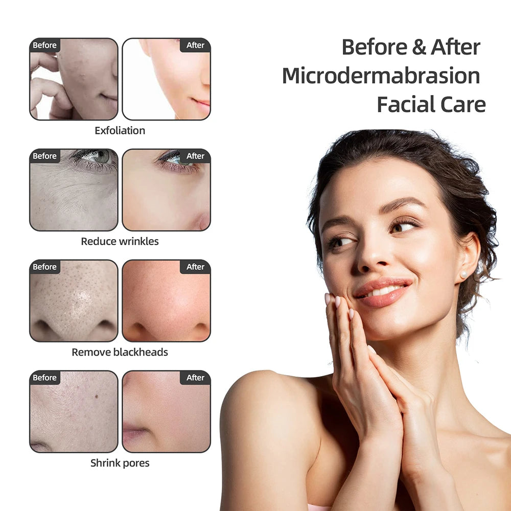 Foreverlily Spa Facial Peeling Deep Cleansing Device For Face